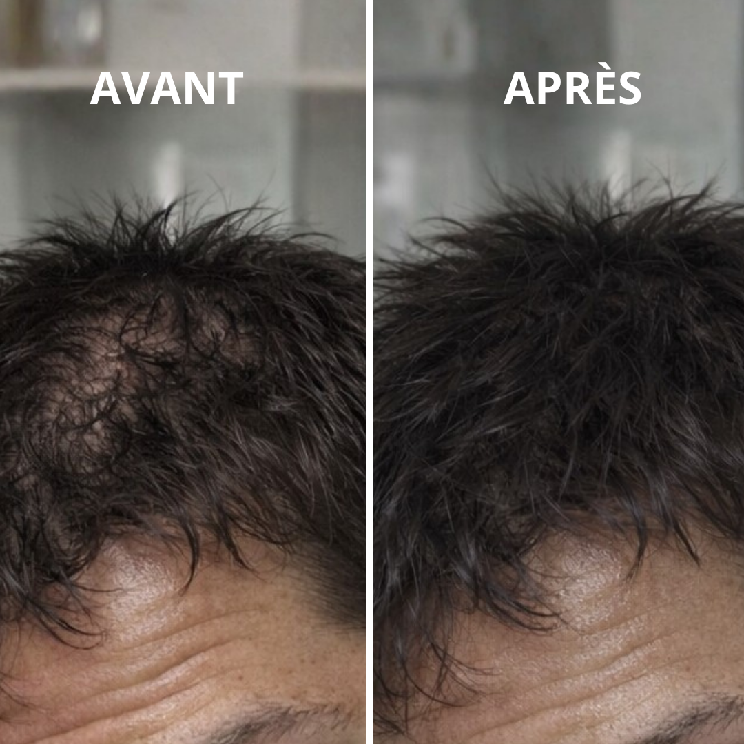 Hairo - La Solution Invisible